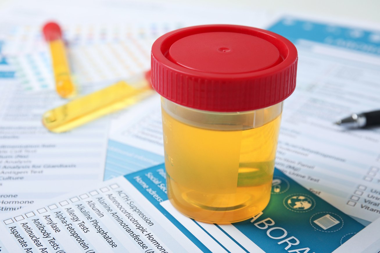 Container with Urine Sample for Analysis on Test Form